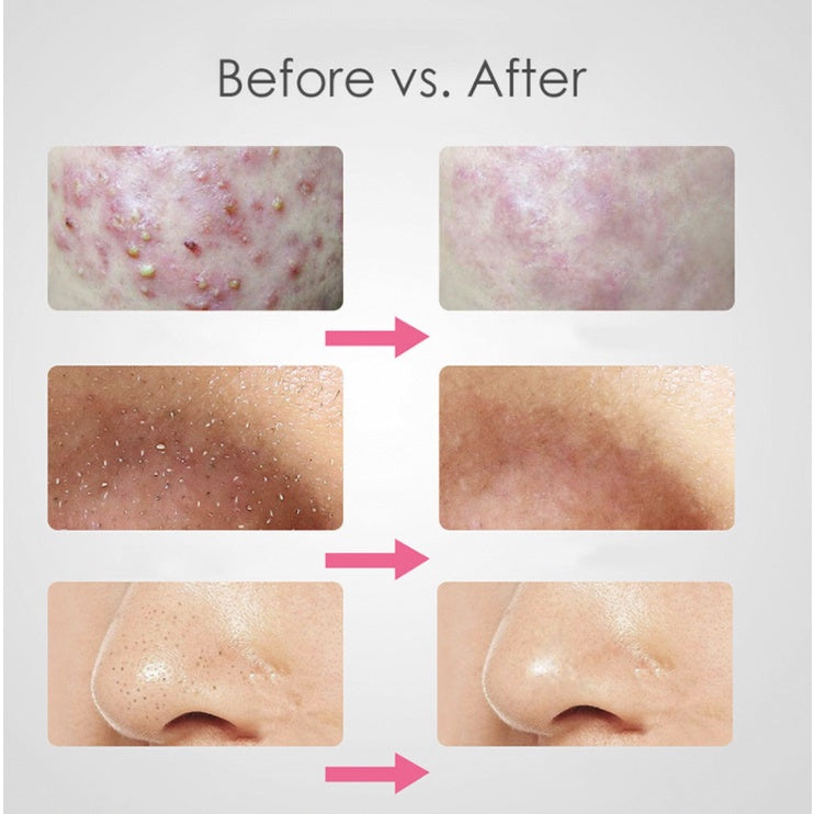 3pcs Acne Blackhead Tweezers | Needle Blemish Pimples Removal Pointed Bend Gib Head Face Care Tools Comedone - Boo & Bub